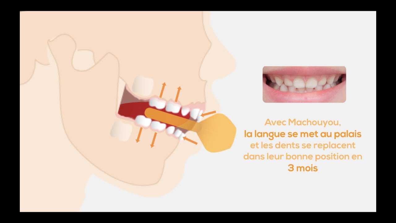 MACHOUYOU Dispositif 1ere Dentition - Sevrage tétine